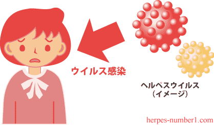 ヘルペスウイルス感染